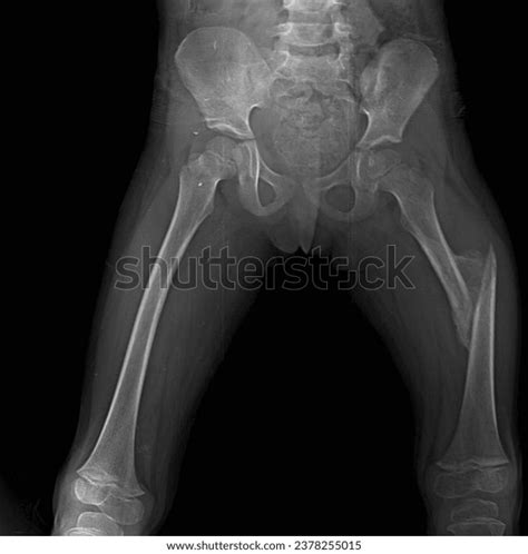 prone bone|Prone Bone